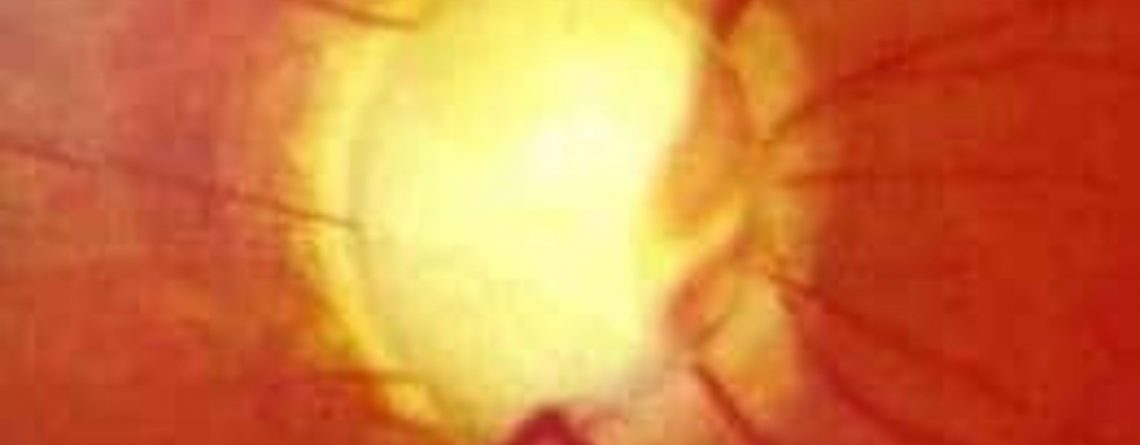 Glaucoma y pérdida de campo visual: cómo la tecnología puede ayudar a mejorar la orientación y la autonomía