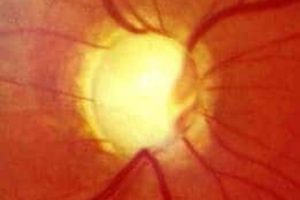 Glaucoma y pérdida de campo visual: cómo la tecnología puede ayudar a mejorar la orientación y la autonomía