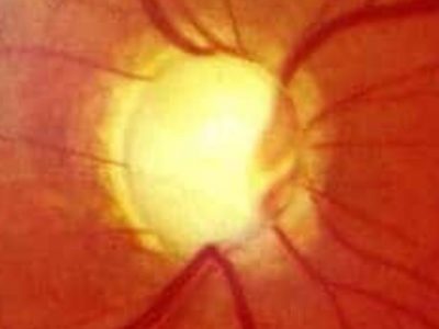 Glaucoma y pérdida de campo visual: cómo la tecnología puede ayudar a mejorar la orientación y la autonomía
